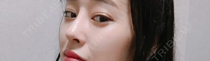 二重埋没 / 隆鼻術 / 豊胸（シリコンバッグ） MIGO（ミゴ）整形外科 DAY 21 メイン用