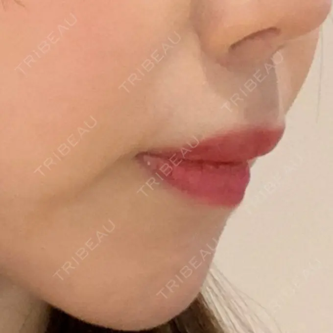 人中短縮 東京皮膚科・形成外科 (銀座いけだクリニック) DAY 457 メイン用