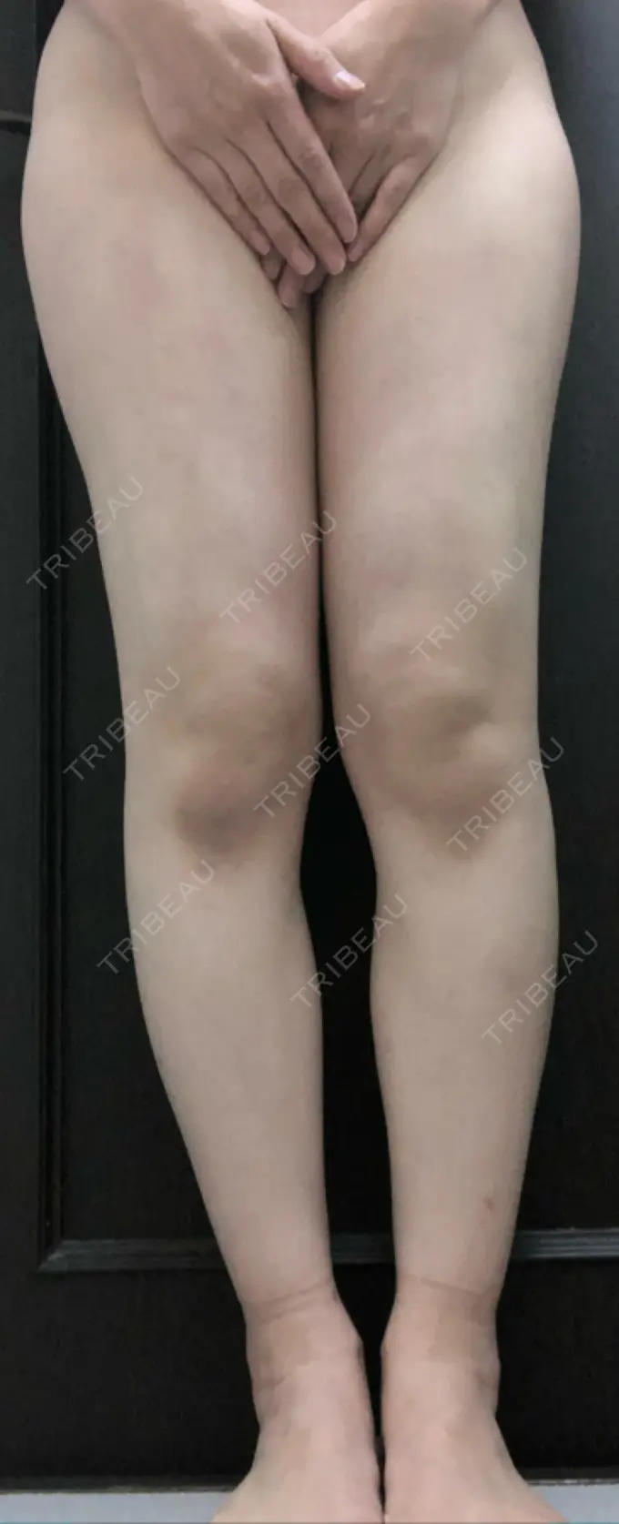 脂肪吸引（脚） / 豊胸（脂肪注入） / 胸修正 THE CLINIC（ザ・クリニック） 名古屋院 DAY 30 メイン用