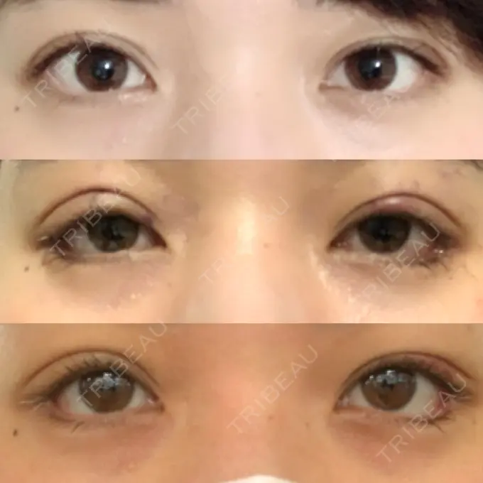 眼瞼下垂（切開） / 目尻切開 / タレ目形成・グラマラスライン（切開） プロミス整形外科 DAY 7 メイン用