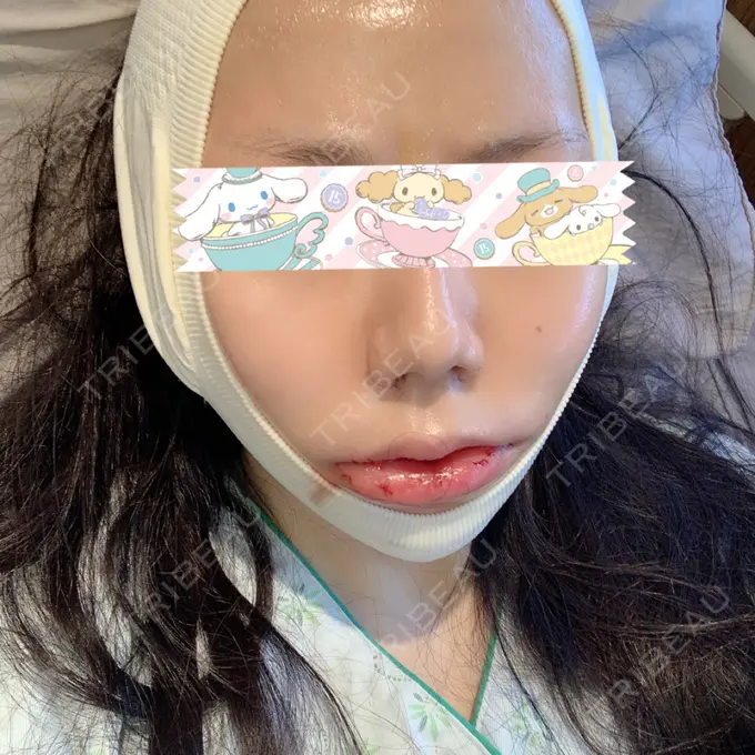 骨切り（あご） / 骨削り（エラ） / ルフォー+ssro（両あご) id（アイディ）美容外科 DAY 2 メイン用