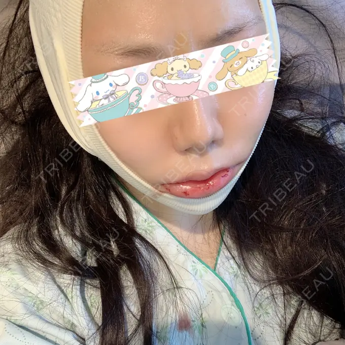 骨切り（あご） / 骨削り（エラ） / ルフォー+ssro（両あご) id（アイディ）美容外科 DAY 2 メイン用