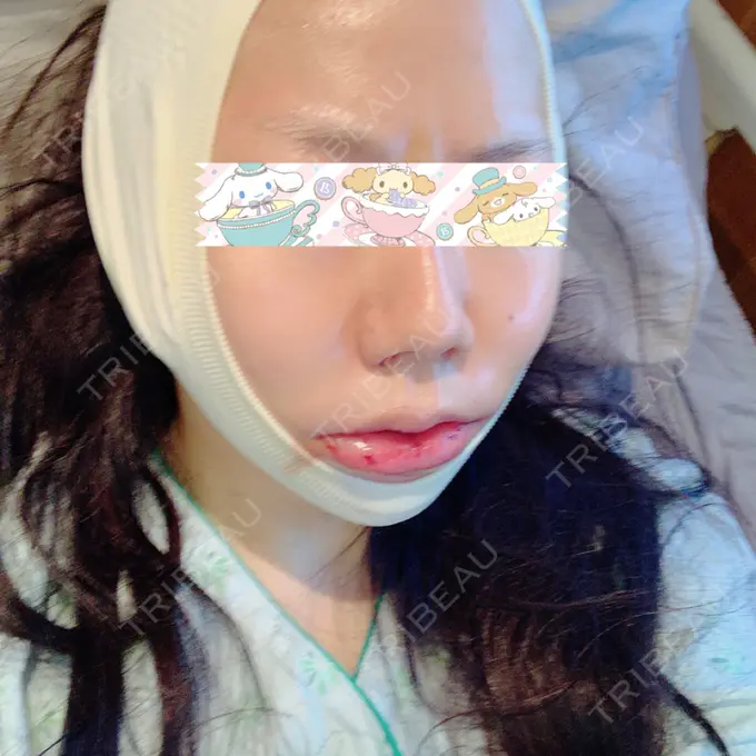 骨切り（あご） / 骨削り（エラ） / ルフォー+ssro（両あご) id（アイディ）美容外科 DAY 2 メイン用