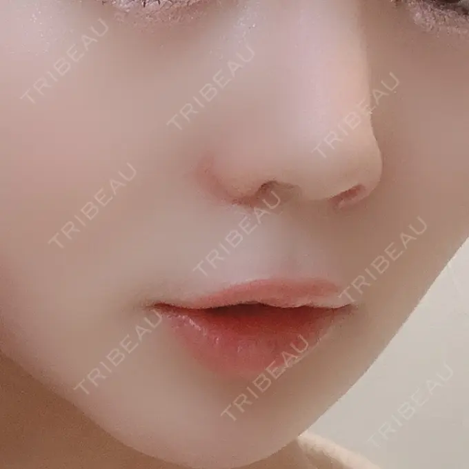 小鼻縮小（切開） / 鼻翼挙上 / 鼻孔縁挙上 大阪TAクリニック DAY 23 メイン用