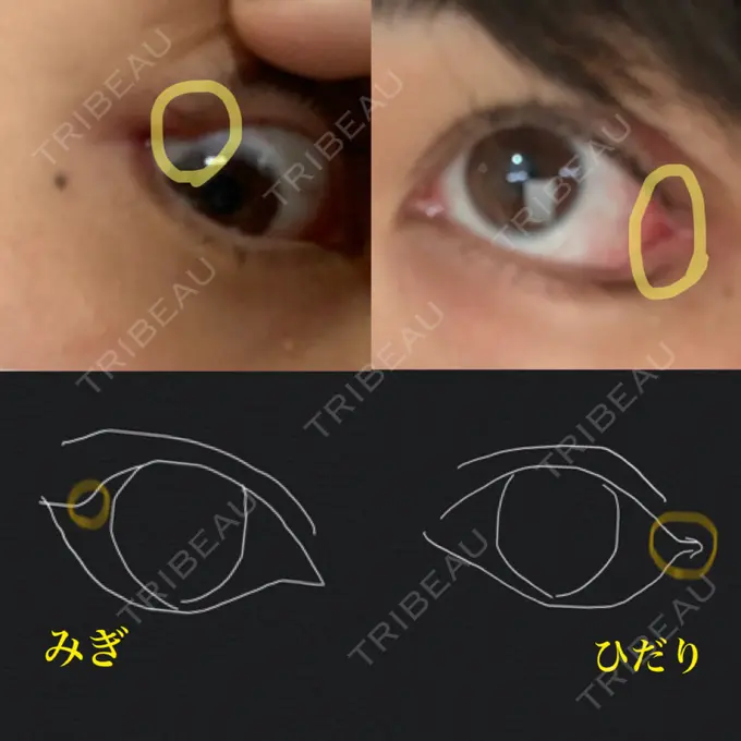 眼瞼下垂（切開） / 目尻切開 / タレ目形成・グラマラスライン（切開） プロミス整形外科 DAY 7 メイン用