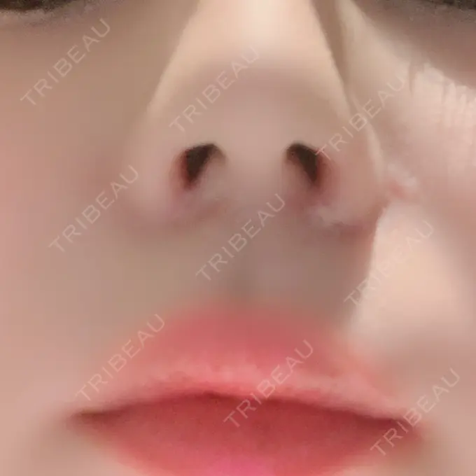 小鼻縮小（切開） / 鼻翼挙上 / 鼻孔縁挙上 大阪TAクリニック AFTER メイン用