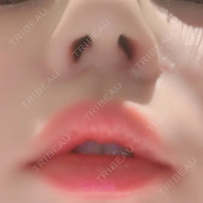 小鼻縮小（切開） / 鼻翼挙上 / 鼻孔縁挙上 大阪TAクリニック DAY 25 メイン用