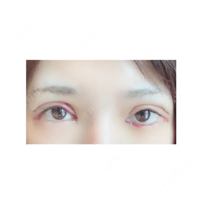 二重切開 / 目頭切開 / 眼瞼下垂（切開） RG整形外科（旧リオン整形外科） DAY 4 メイン用