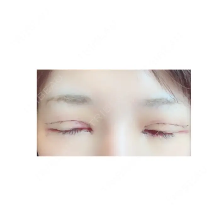 二重切開 / 目頭切開 / 眼瞼下垂（切開） RG整形外科（旧リオン整形外科） DAY 4 メイン用