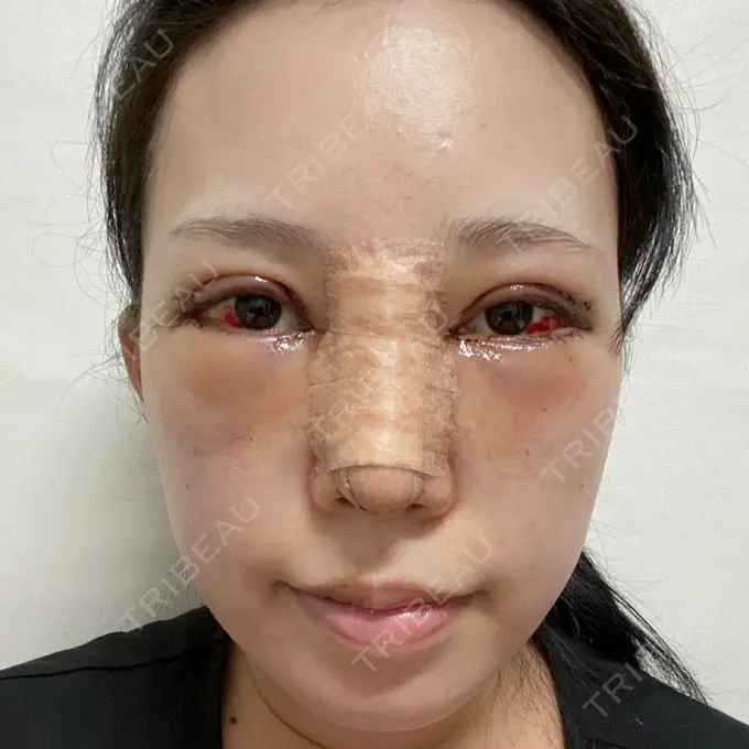 目頭切開 / 鼻尖形成（切開） / 額を丸く / 目尻切開 / 上まぶたの脂肪取り / 軟骨移植 / 脂肪注入（輪郭） TN整形外科 DAY 1 メイン用