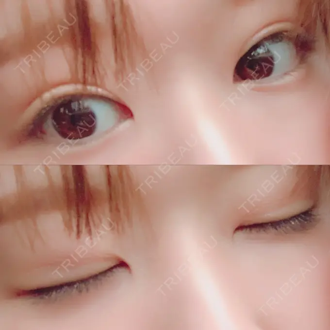 二重埋没 湘南美容クリニック 金沢院 DAY 2 メイン用