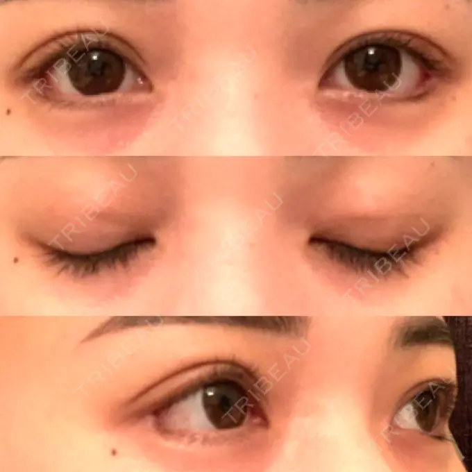 眼瞼下垂（切開） / 目尻切開 / タレ目形成・グラマラスライン（切開） プロミス整形外科 DAY 8 メイン用