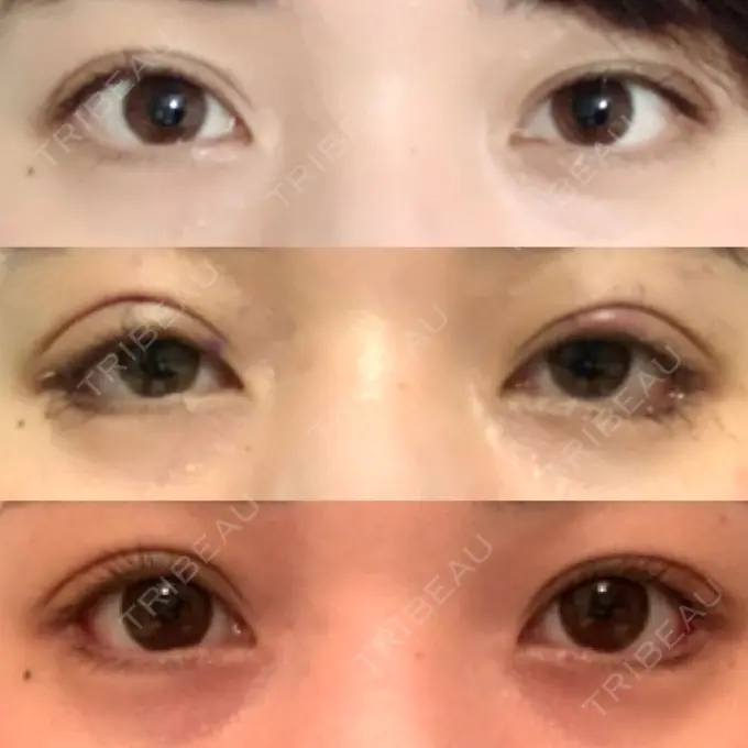 眼瞼下垂（切開） / 目尻切開 / タレ目形成・グラマラスライン（切開） プロミス整形外科 DAY 8 メイン用