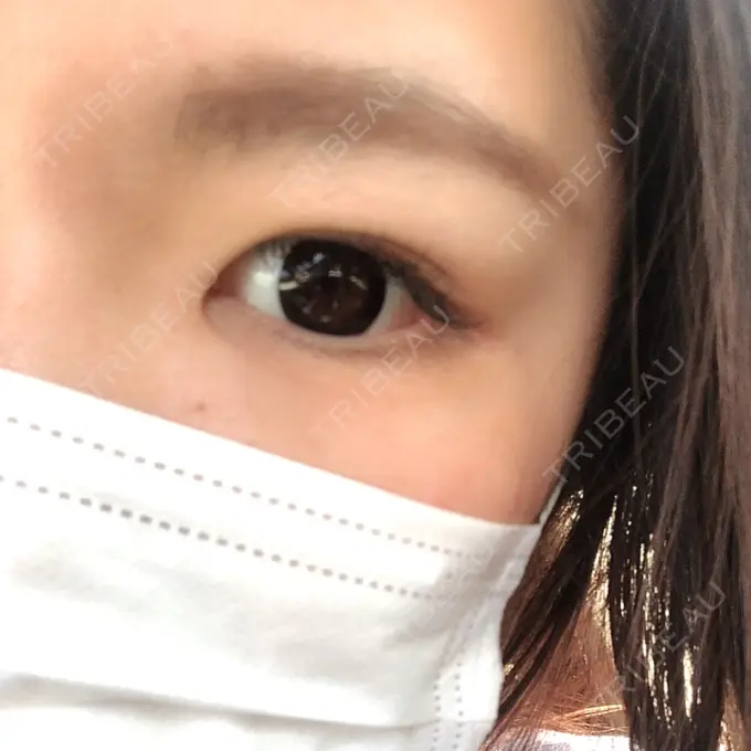 二重埋没 城本クリニック 福岡院 AFTER メイン用