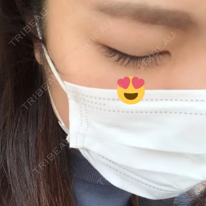 二重埋没 城本クリニック 福岡院 DAY 310 メイン用