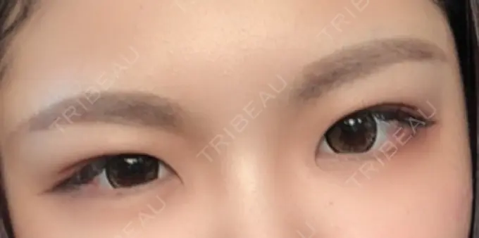 二重埋没 城本クリニック 福岡院 DAY 310 メイン用