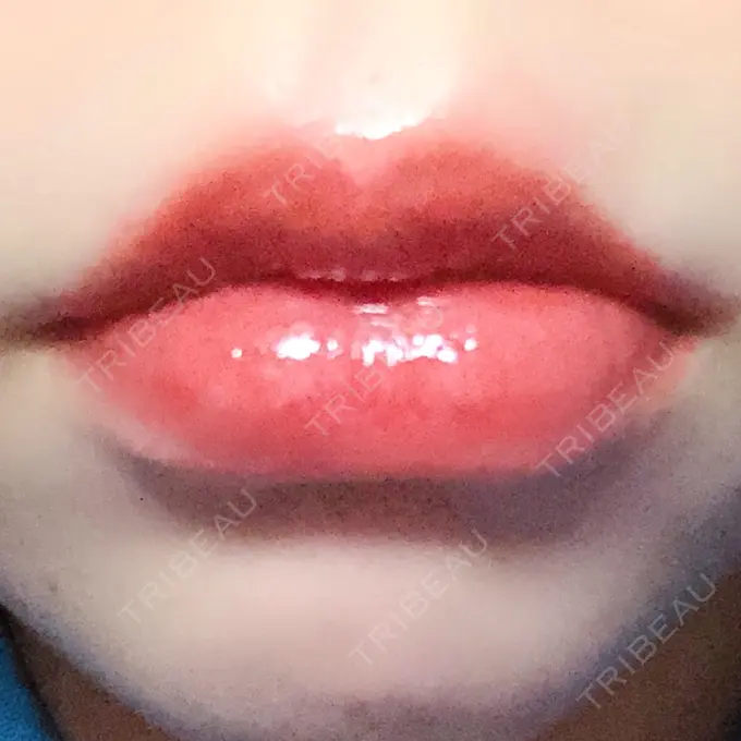 ヒアルロン酸注入（唇） / ボトックス（口角） リエンジャン整形外科 江南店 AFTER メイン用