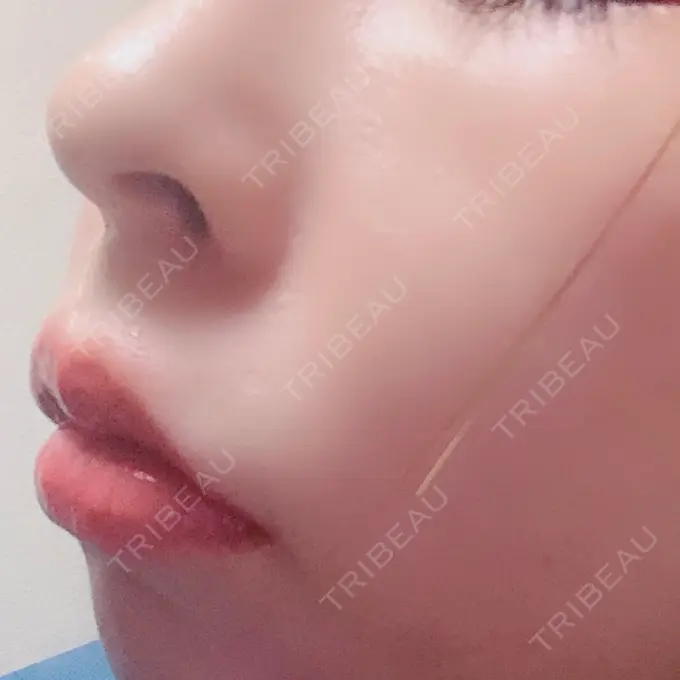 ヒアルロン酸注入（唇） / ボトックス（口角） リエンジャン整形外科 江南店 DAY 20 メイン用