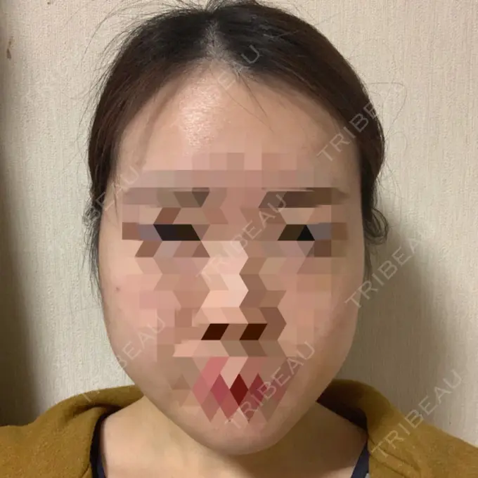 糸リフト / 骨切り（あご） / 骨削り（エラ） RG整形外科（旧リオン整形外科） DAY 12 メイン用