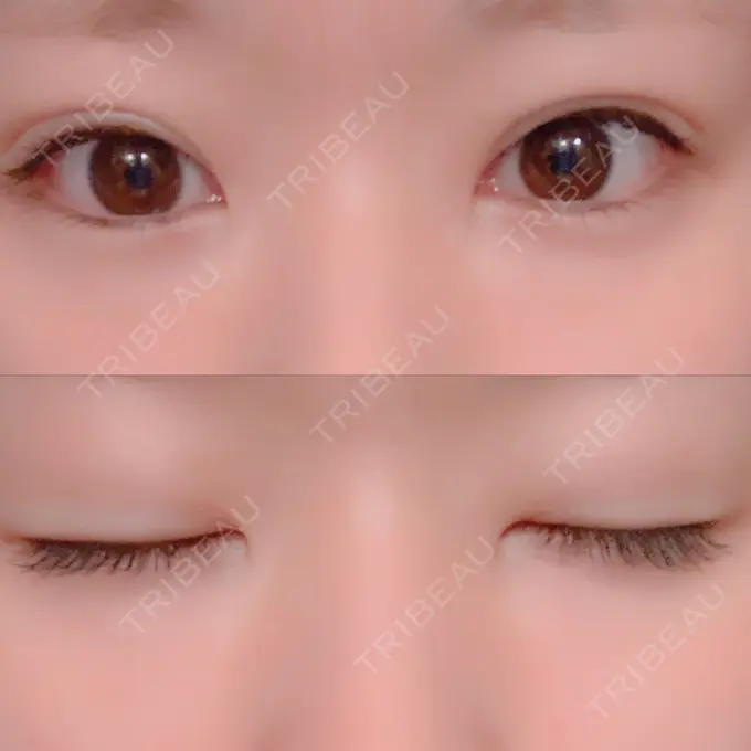 二重埋没 湘南美容クリニック 金沢院 DAY 4 メイン用