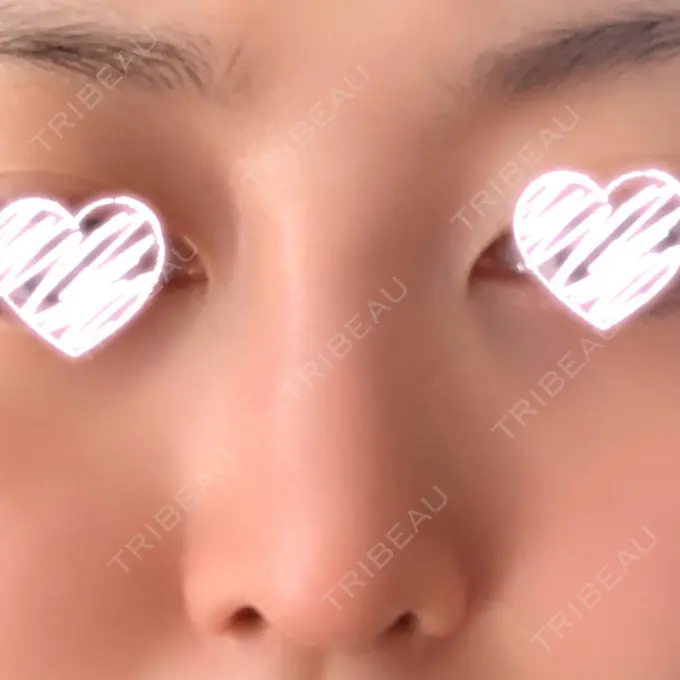 隆鼻術 / 軟骨移植 みずほクリニック DAY 94 メイン用