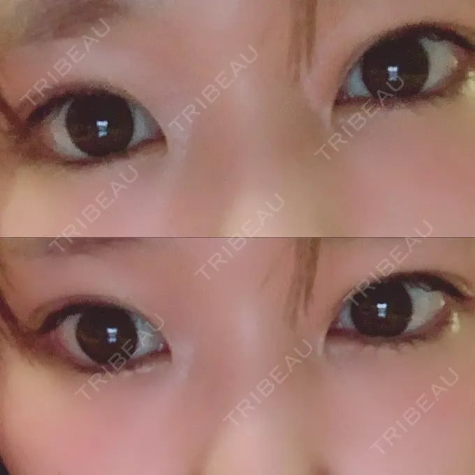 二重埋没 湘南美容クリニック 金沢院 DAY 4 メイン用