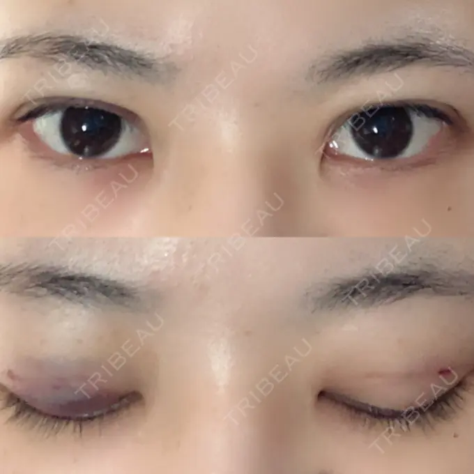 二重埋没 / 上まぶたの脂肪取り 湘南美容クリニック 柏院 DAY 1 メイン用