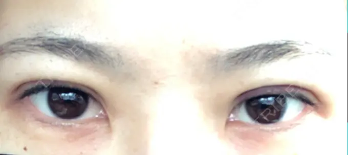 二重埋没 / 上まぶたの脂肪取り 湘南美容クリニック 柏院 DAY 1 メイン用