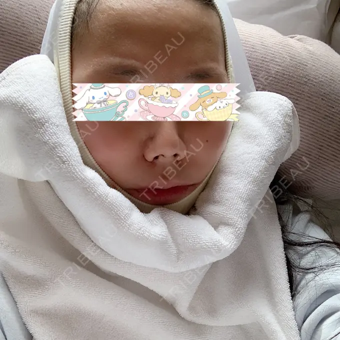 骨切り（あご） / 骨削り（エラ） / ルフォー+ssro（両あご) id（アイディ）美容外科 DAY 3 メイン用