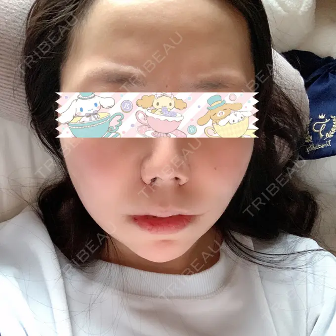 骨切り（あご） / 骨削り（エラ） / ルフォー+ssro（両あご) id（アイディ）美容外科 DAY 3 メイン用