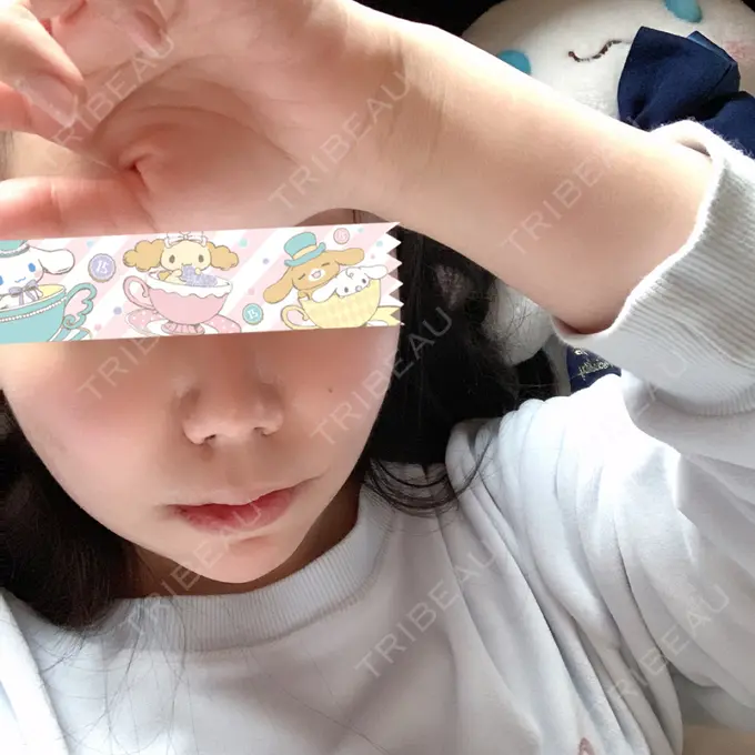 骨切り（あご） / 骨削り（エラ） / ルフォー+ssro（両あご) id（アイディ）美容外科 DAY 3 メイン用