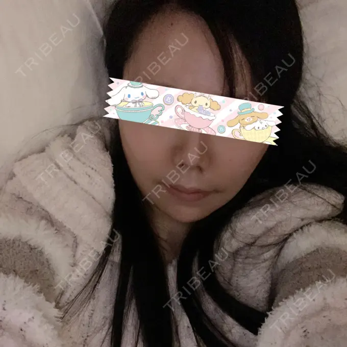 骨切り（あご） / 骨削り（エラ） / ルフォー+ssro（両あご) id（アイディ）美容外科 AFTER メイン用