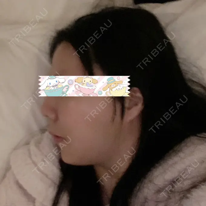 骨切り（あご） / 骨削り（エラ） / ルフォー+ssro（両あご) id（アイディ）美容外科 DAY 5 メイン用