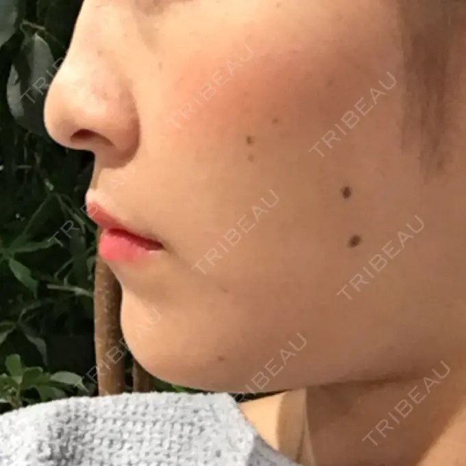 バッカルファット除去 / 脂肪吸引（顔） / セットバック 銀座フェイスクリニック（小顔整形・輪郭整形專門） DAY 99 メイン用