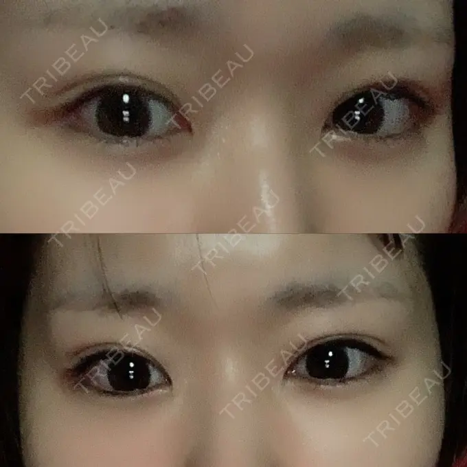 二重埋没 湘南美容クリニック 金沢院 DAY 5 メイン用