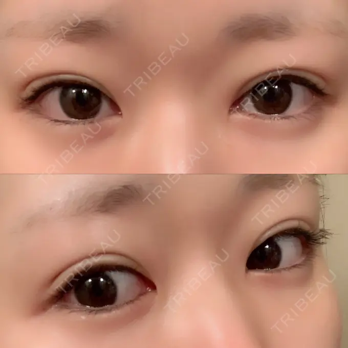 二重埋没 湘南美容クリニック 金沢院 DAY 5 メイン用