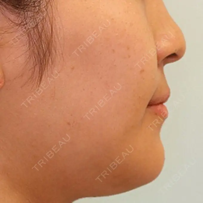 バッカルファット除去 / 脂肪吸引（顔） / セットバック 銀座フェイスクリニック（小顔整形・輪郭整形專門） DAY 98 メイン用