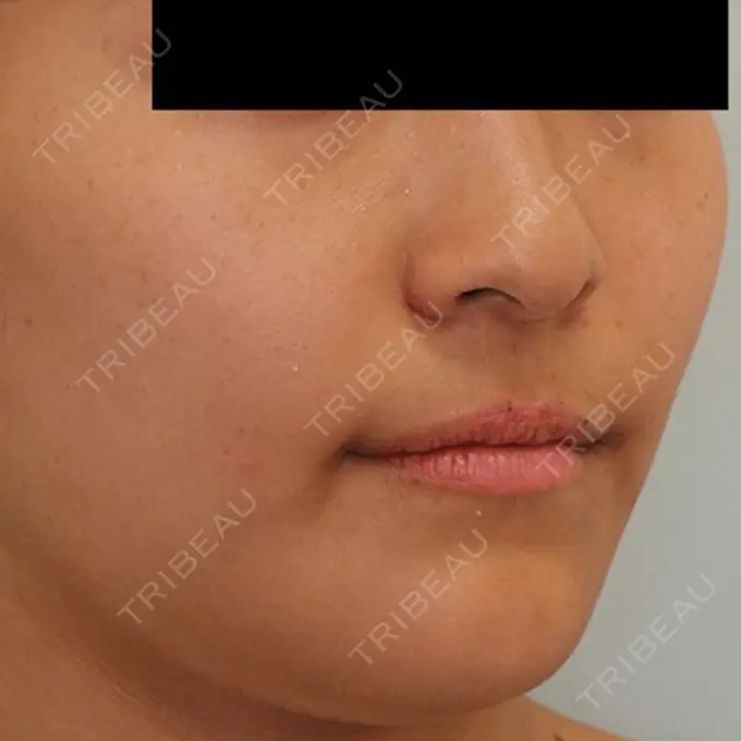 バッカルファット除去 / 脂肪吸引（顔） / セットバック 銀座フェイスクリニック（小顔整形・輪郭整形專門） DAY 98 メイン用