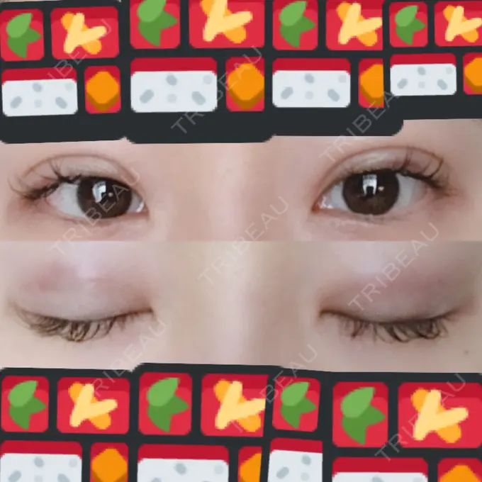 二重埋没 湘南美容クリニック 東京蒲田院 DAY 3 メイン用