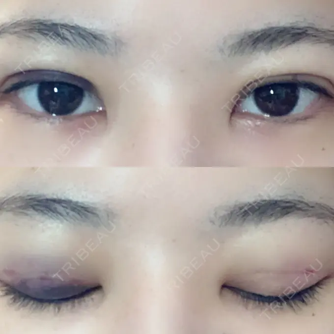 二重埋没 / 上まぶたの脂肪取り 湘南美容クリニック 柏院 DAY 2 メイン用