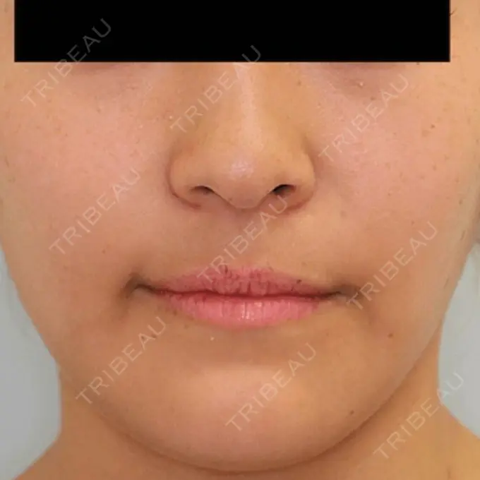 バッカルファット除去 / 脂肪吸引（顔） / セットバック 銀座フェイスクリニック（小顔整形・輪郭整形專門） DAY 98 メイン用