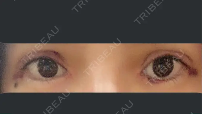 二重切開 / 目頭切開 / 眼瞼下垂（切開） RG整形外科（旧リオン整形外科） DAY 6 メイン用