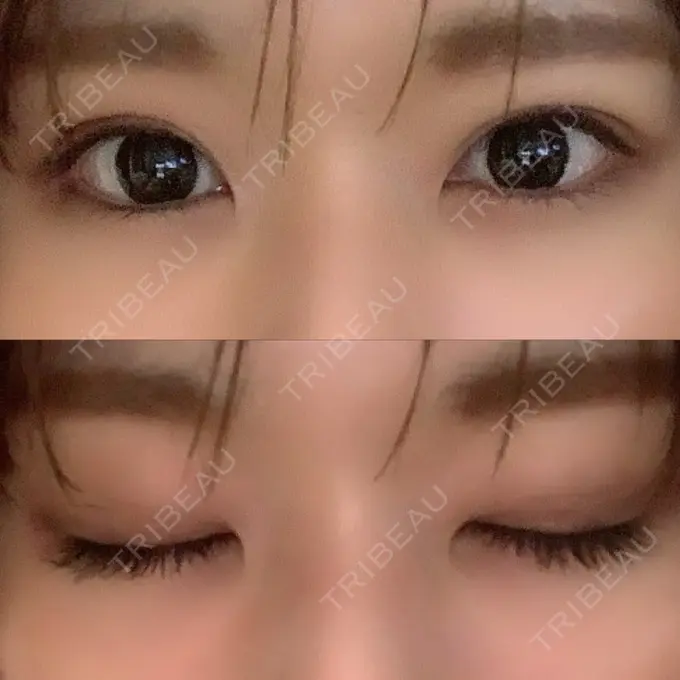 二重埋没 湘南美容クリニック 金沢院 DAY 5 メイン用