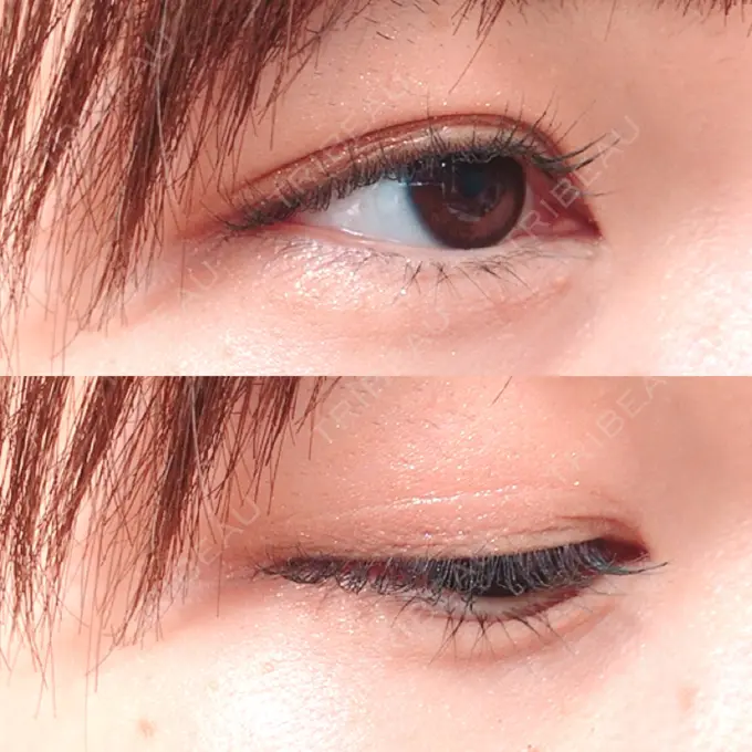 二重埋没 新宿美容外科クリニック 立川院 DAY 122 メイン用