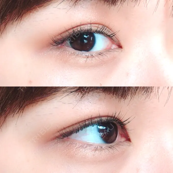 二重埋没 新宿美容外科クリニック 立川院 DAY 122 メイン用