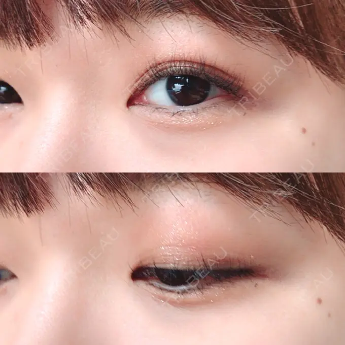 二重埋没 新宿美容外科クリニック 立川院 AFTER メイン用