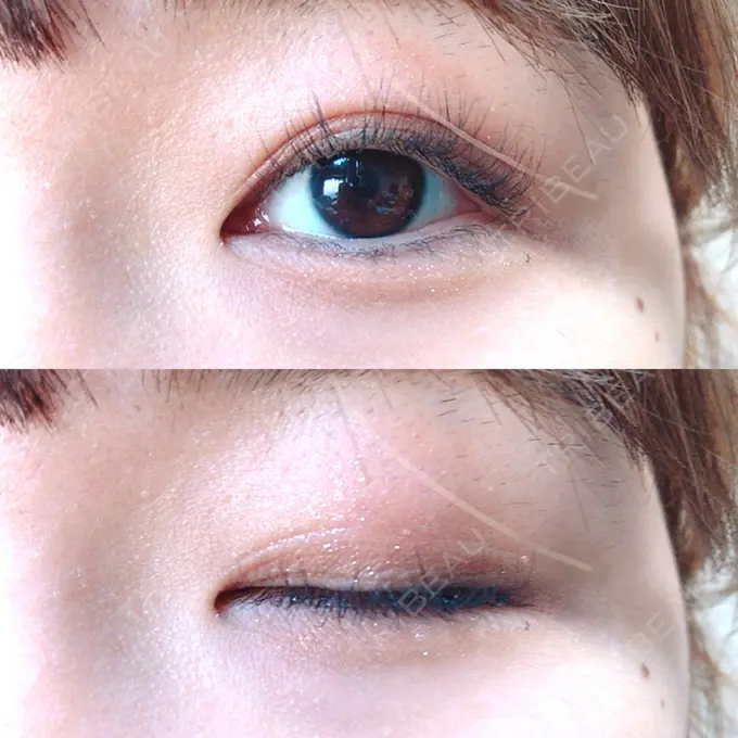 二重埋没 新宿美容外科クリニック 立川院 DAY 122 メイン用