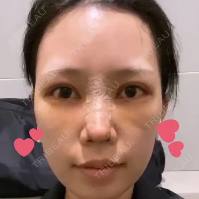 目頭切開 / 鼻尖形成（切開） / 額を丸く / 目尻切開 / 上まぶたの脂肪取り / 軟骨移植 / 脂肪注入（輪郭） TN整形外科 DAY 5 メイン用