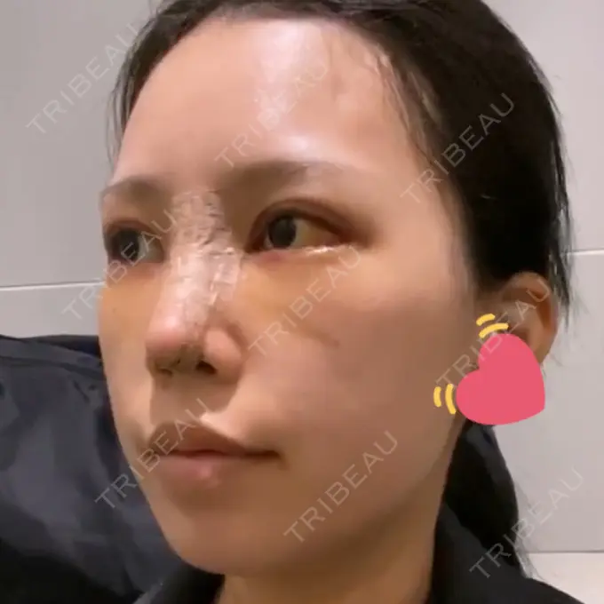 目頭切開 / 鼻尖形成（切開） / 額を丸く / 目尻切開 / 上まぶたの脂肪取り / 軟骨移植 / 脂肪注入（輪郭） TN整形外科 DAY 5 メイン用