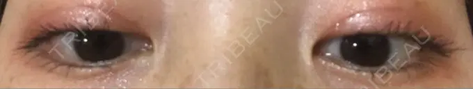 二重埋没 湘南美容クリニック 京都院 DAY 33 メイン用